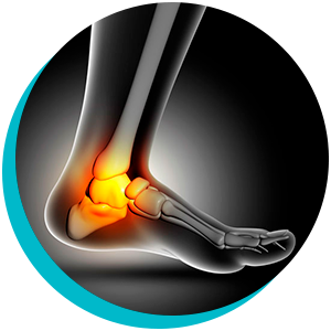 Fascite Plantar: Compreendendo, Tratando e Recuperando com a Fisioterapia