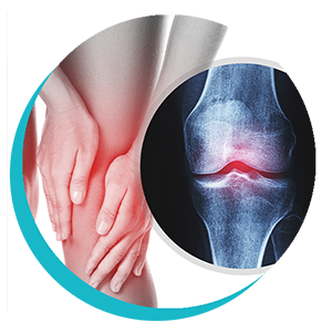 Lesão Osteocondral